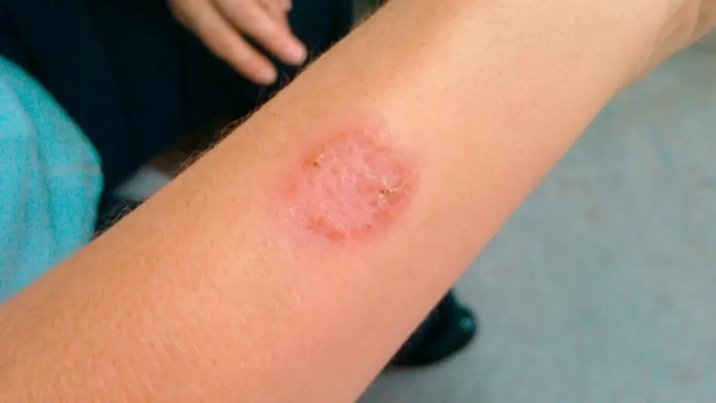 Alerta sanitaria: confirmaron dos casos de leishmaniasis cutánea en Salta durante 2026